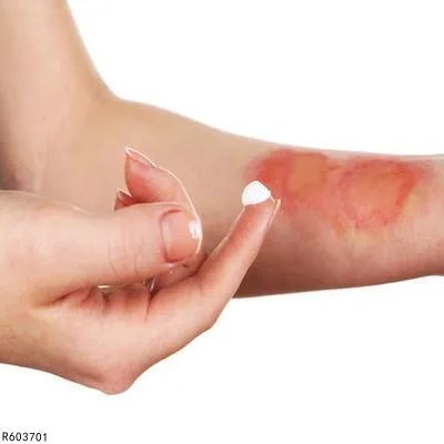 氨水烫伤皮肤怎么处理