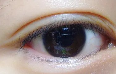 做双眼皮开眼角是怎么做的