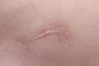 疤痕体质如何治疗