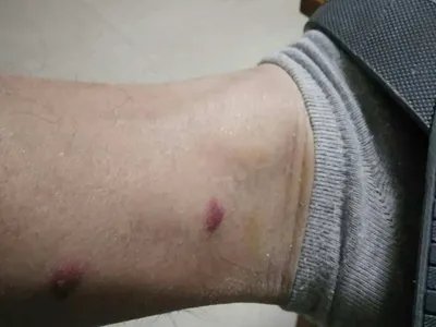 丘疹性荨麻疹脚踝疙瘩图片