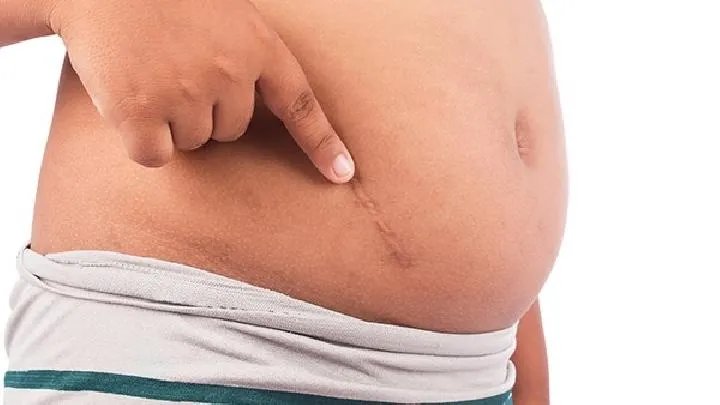 疤痕的非手术疗法