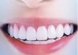 地包天矫正得多少钱