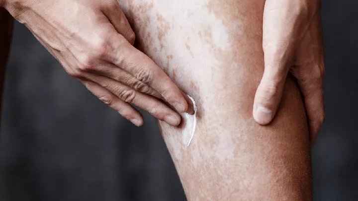 治疗白癜风医院哪里较好，白癜风患者的饮食要注意什么