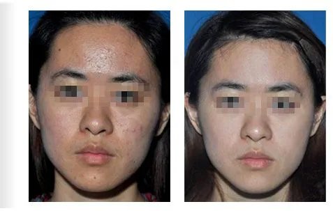 像素激光去疤多少钱