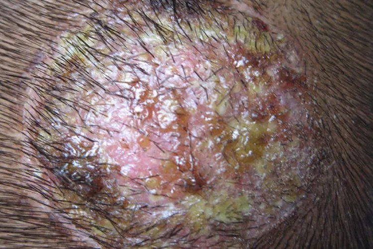 癣的种类与辨别图片